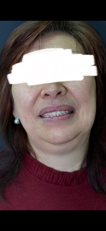 художественная реставрация зубов композитными материалами: Адрес: Бишкек, проспект Жибек-Жолу, 215 Чистка 3х этапная 1500 сом