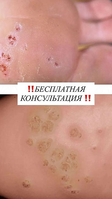 Маникюр: Подолог Бишкек услуги подолога Вросший ноготь. Коррекция вросшего — 1