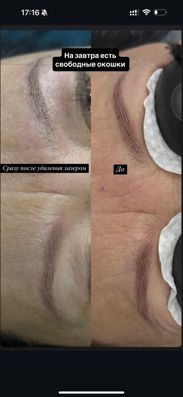 Перманентный макияж: АКЦИЯ !АКЦИЯ! Новый метод удаления Сейчас по акции Лазерное удаление — 9