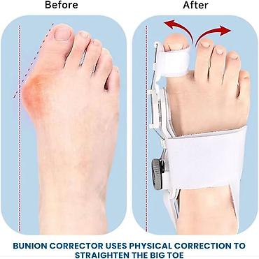etir aparati: Halluks Valqus Tənzimlənən Korektoru (Bunion Corrector) Məhsul — 3