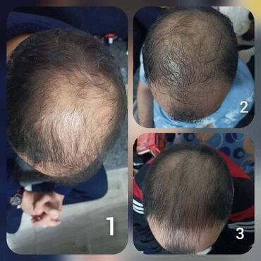 Nega kose: KosaLim 💚 Kosalim je kombinacija prirodnih ekstrakta lekovitog bilja na lalafo.rs — 3 Nega kose: KosaLim 💚 Kosalim je kombinacija prirodnih ekstrakta lekovitog bilja — 3