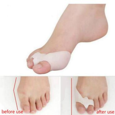 гвозди для ног: Ортопедический корректор вальгусной деформации большого пальца стопы