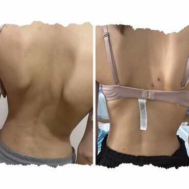 Masaj: Vakuum masajı, Qadınlar üçün — 3