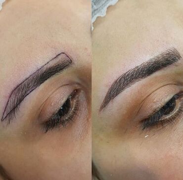 Kirpiklər, qaşlar: Seyrek formasiz qaslarin mikrobledinqle berpasi — 2