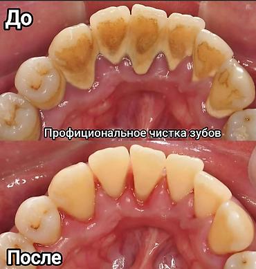 Стоматологи: Съёмные зубные протезы под ваши задачи - Вакуумные протезы: плотная — 7