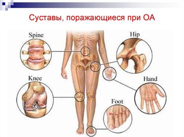 Уход за телом: Бишофит от чего помогает. опорно-двигательного аппарата — 6