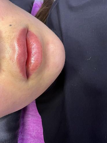 Косметология: Косметология, Ботокс, Биоревитализация, Ботулинотерапия, Консультация, Гипоаллергенные материалы, Сертифицированный косметолог at lalafo.kg — 21 Косметология: Косметология, Ботокс, Биоревитализация, Ботулинотерапия, Консультация, Гипоаллергенные материалы, Сертифицированный косметолог — 21