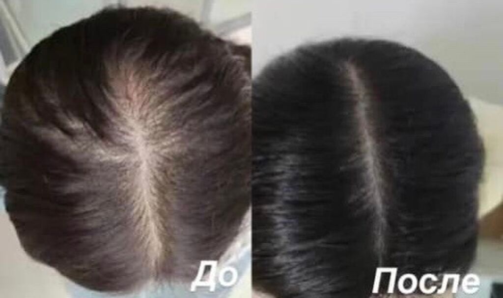 Спрей от выпадения волос от алопеции от лысины для роста, густоты — фото 4