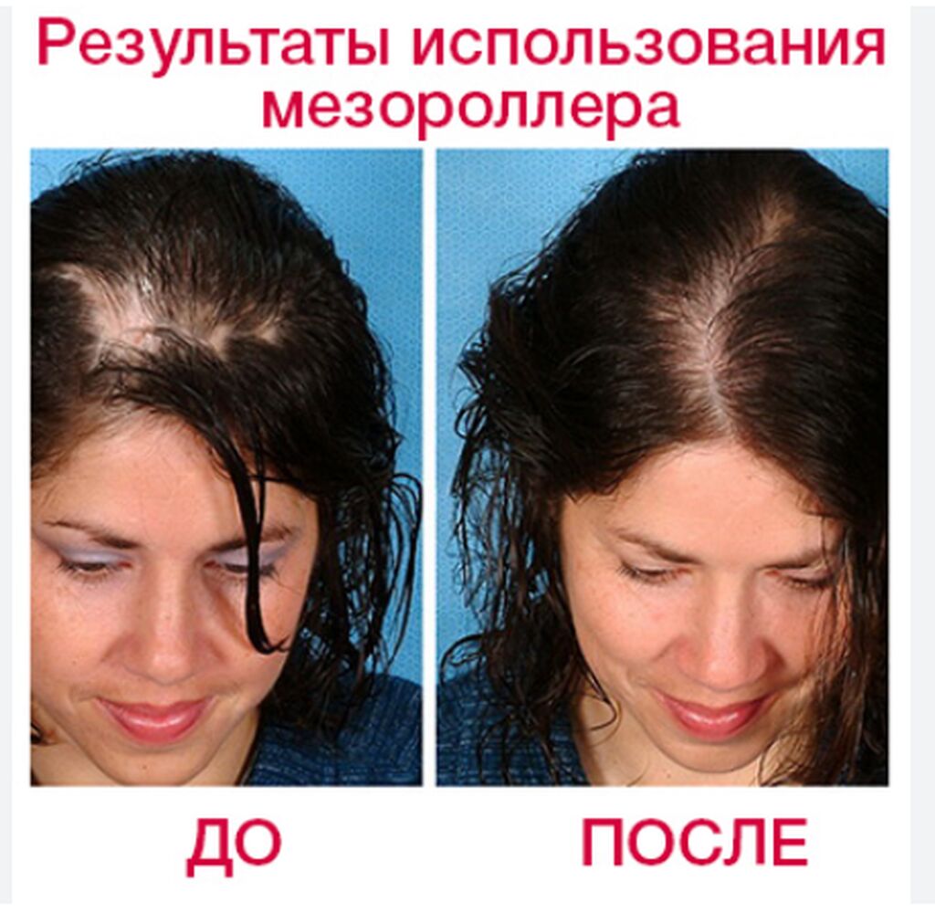 Мезотерапия волос головы до и после