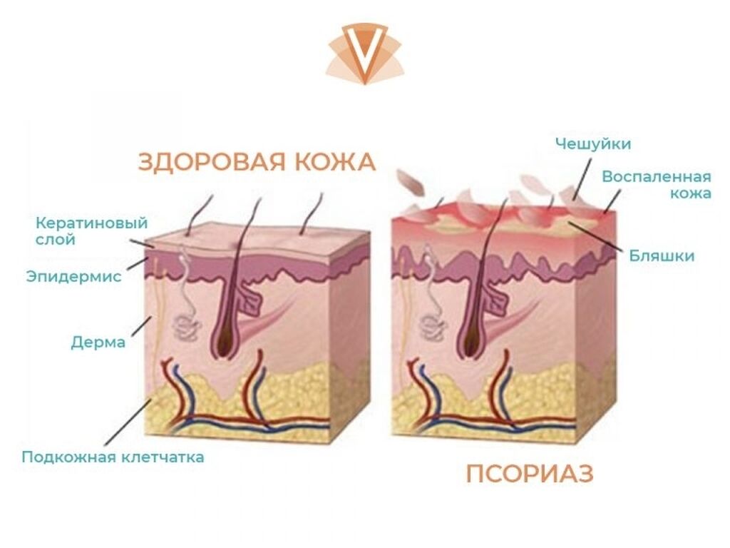 Человеческий волос под микроскопом. Чешуйки перхоти под микроскопом. Нормальная кожа головки. Нормальная кожа головки. Типы волос жирные сухие нормальные.