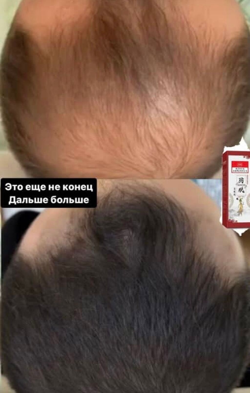 Спрей от выпадения волос от алопеции от лысины для роста, густоты — фото 3