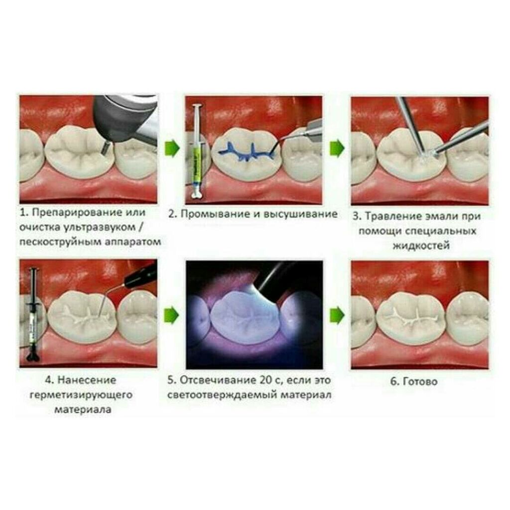 Герметизация фиссур молочного зуба (инвазивный метод)