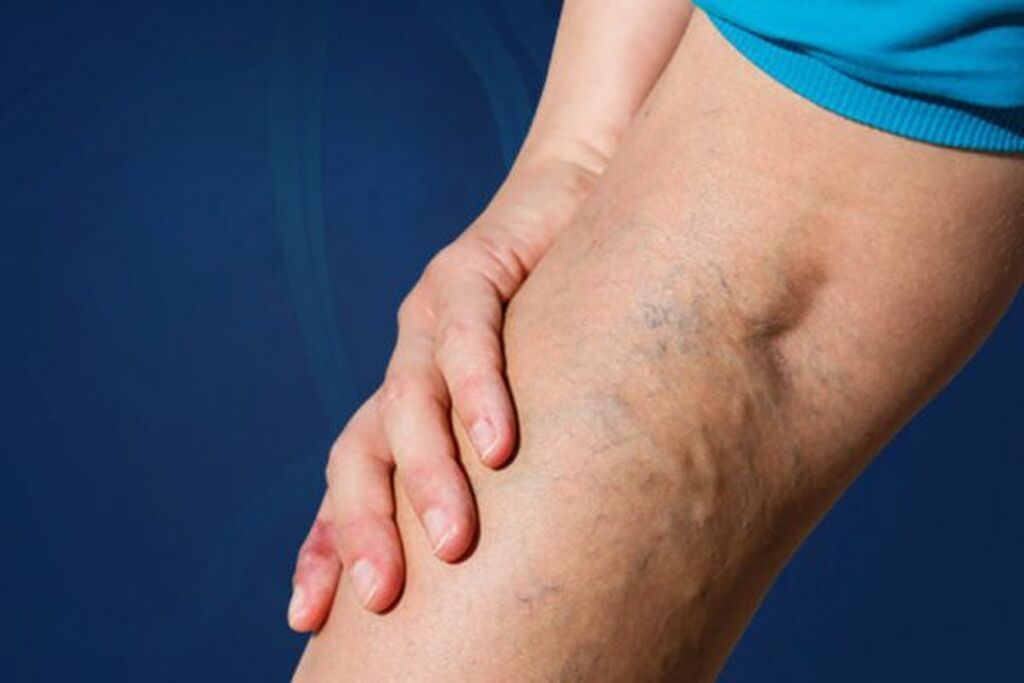 Klinikada varikoz damar müalicəsi - 2