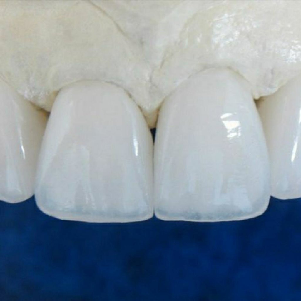 диоксид циркония фото зубов