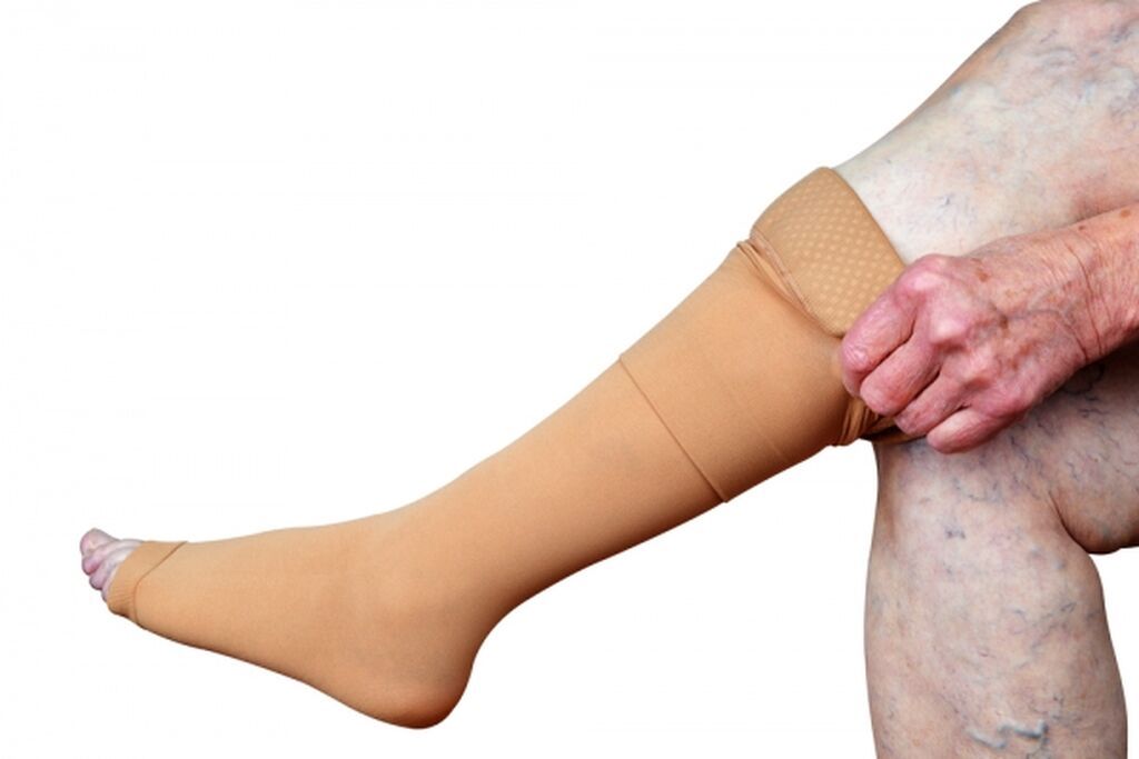 Klinikada varikoz damar müalicəsi - 3