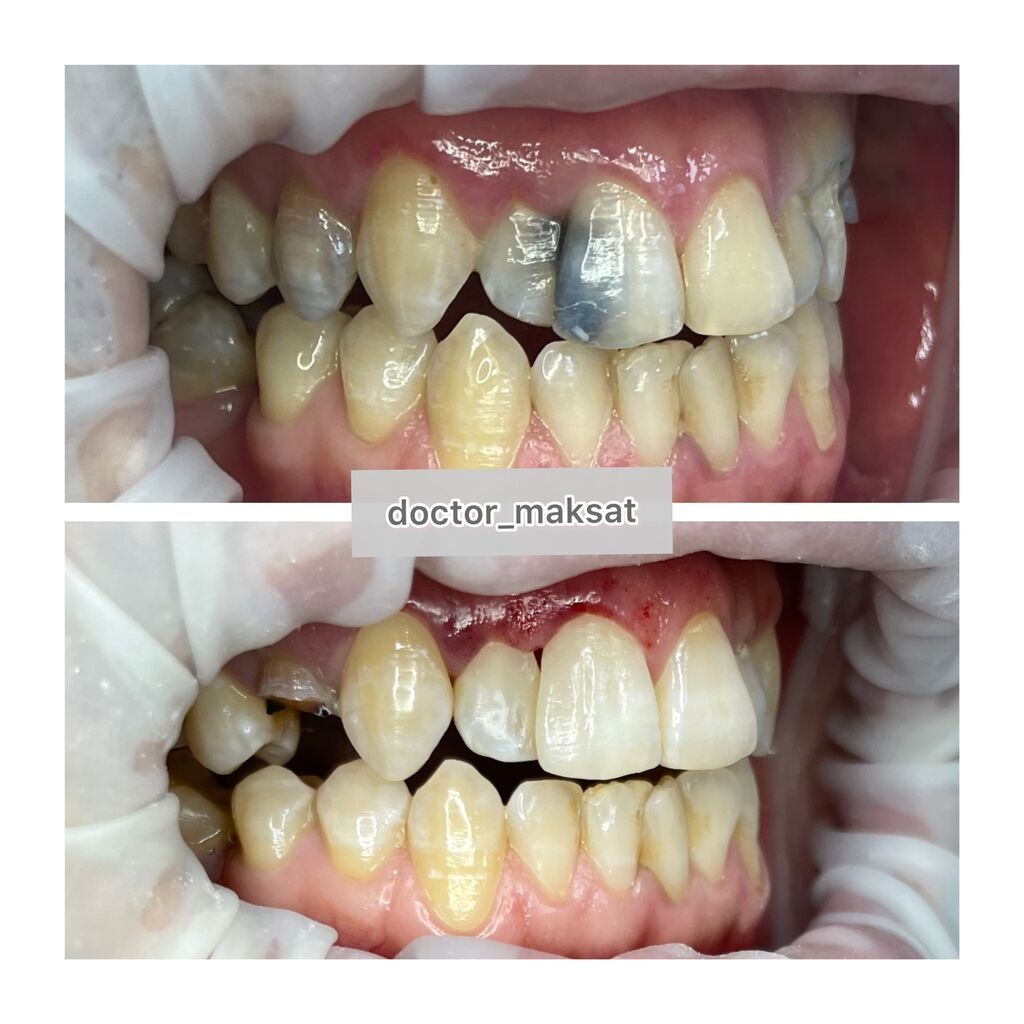 Реставрация зуба, пломба, лечение кариеса без боли! | Договорная ...