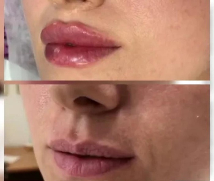 Эффект после филлера. Эффект Тиндаля после филлера в губы. Эффект Тиндаля это косметология губы. Филлер на губах эффект Тиндаля.