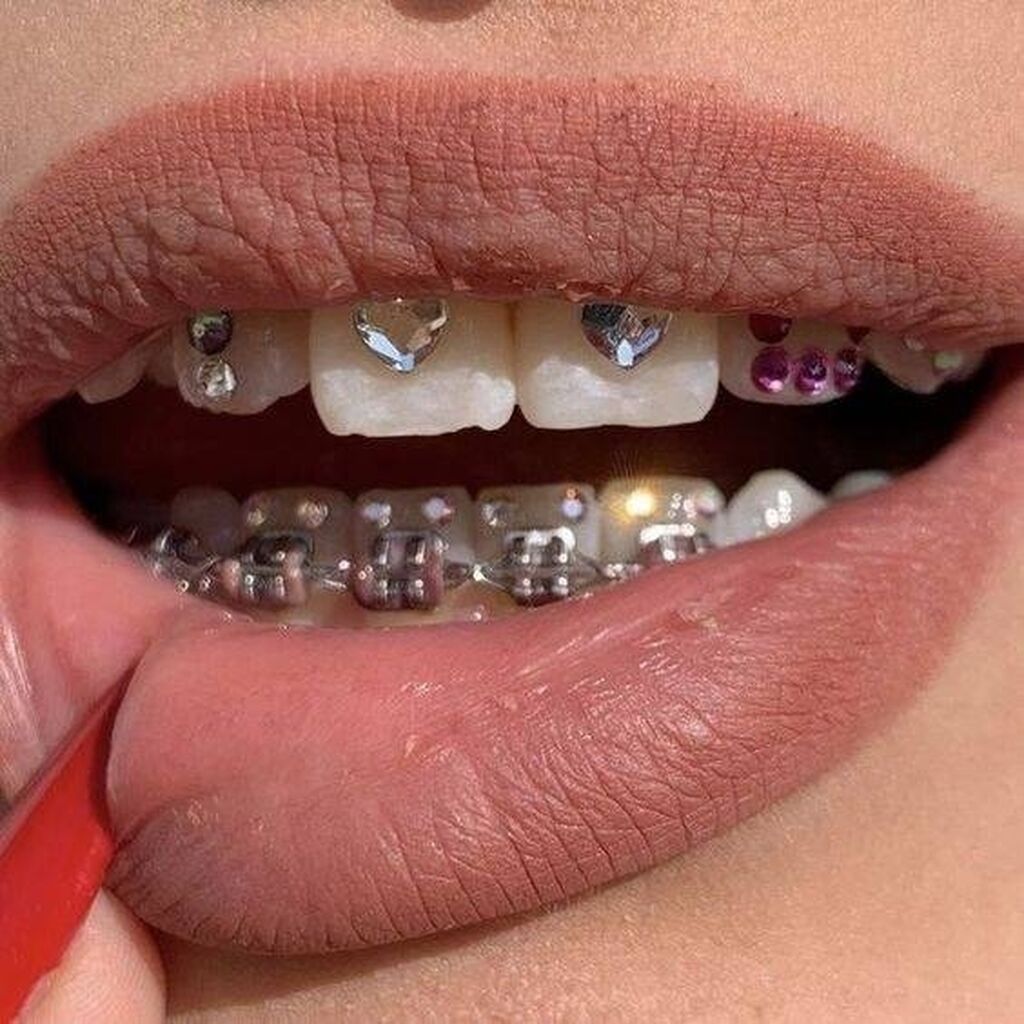 кольцо на зубы детям