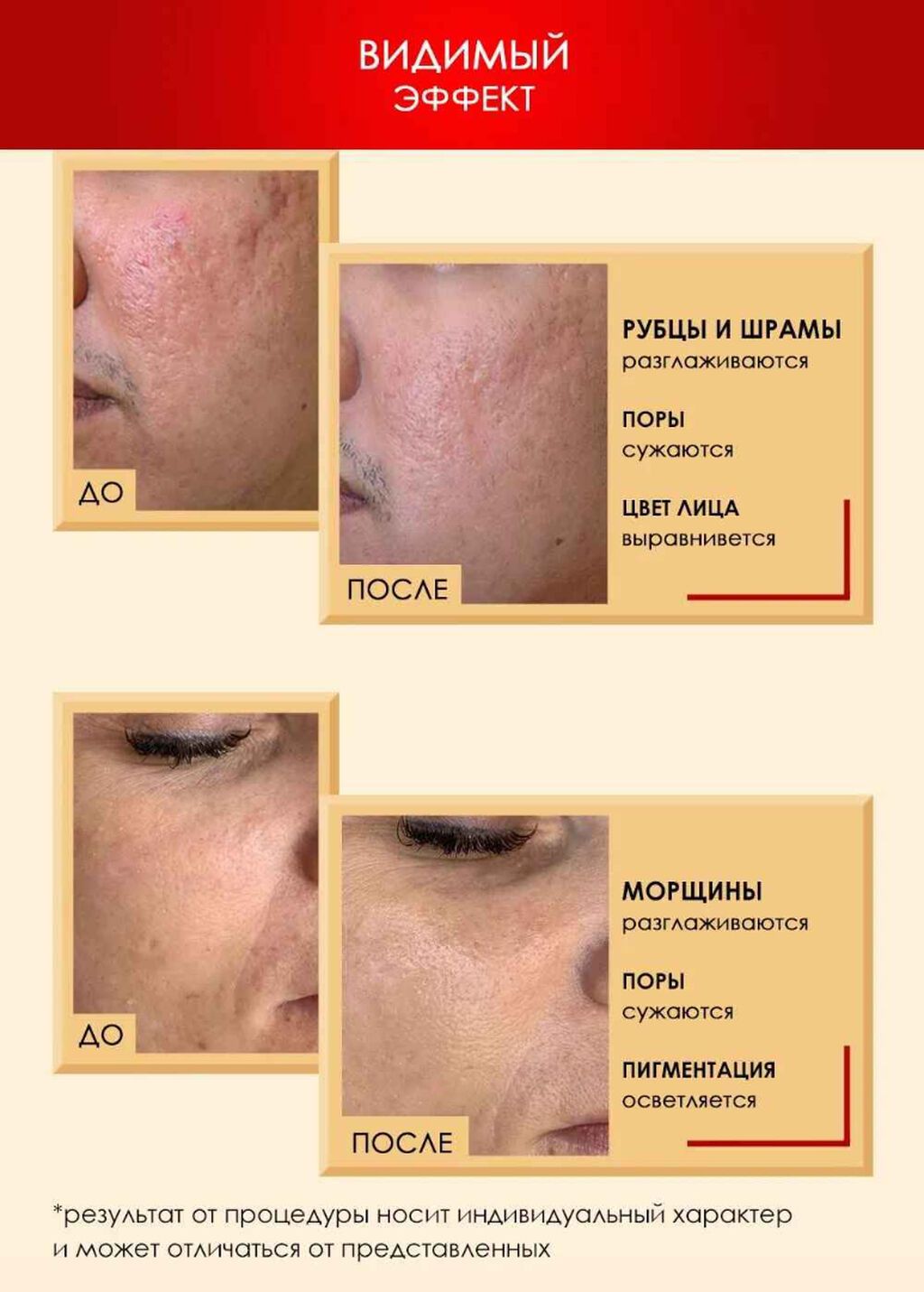 Дермапэн Wellinger + 5 картриджей (дермаручка, мезороллер: фото 3