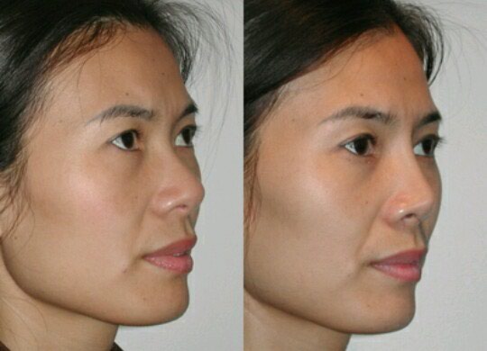 Asian nose bridge surgery