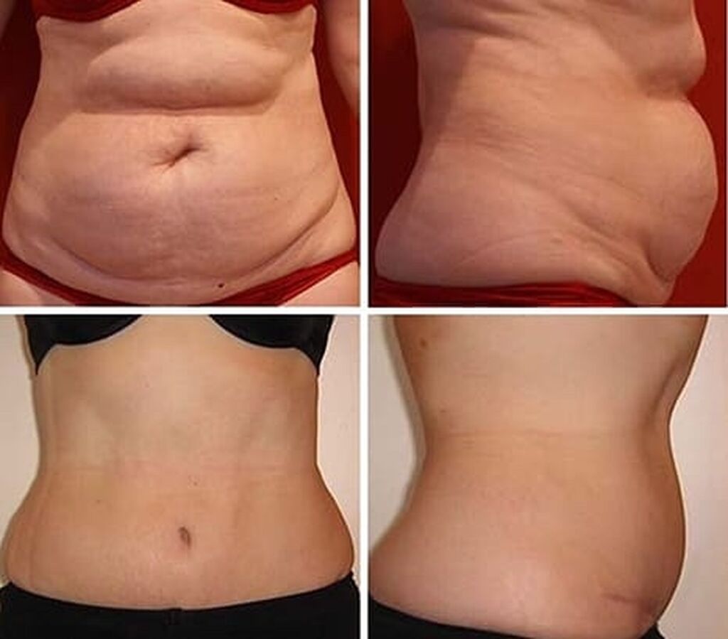 Уколами убрать живот быстро Уколами убрать живот быстро