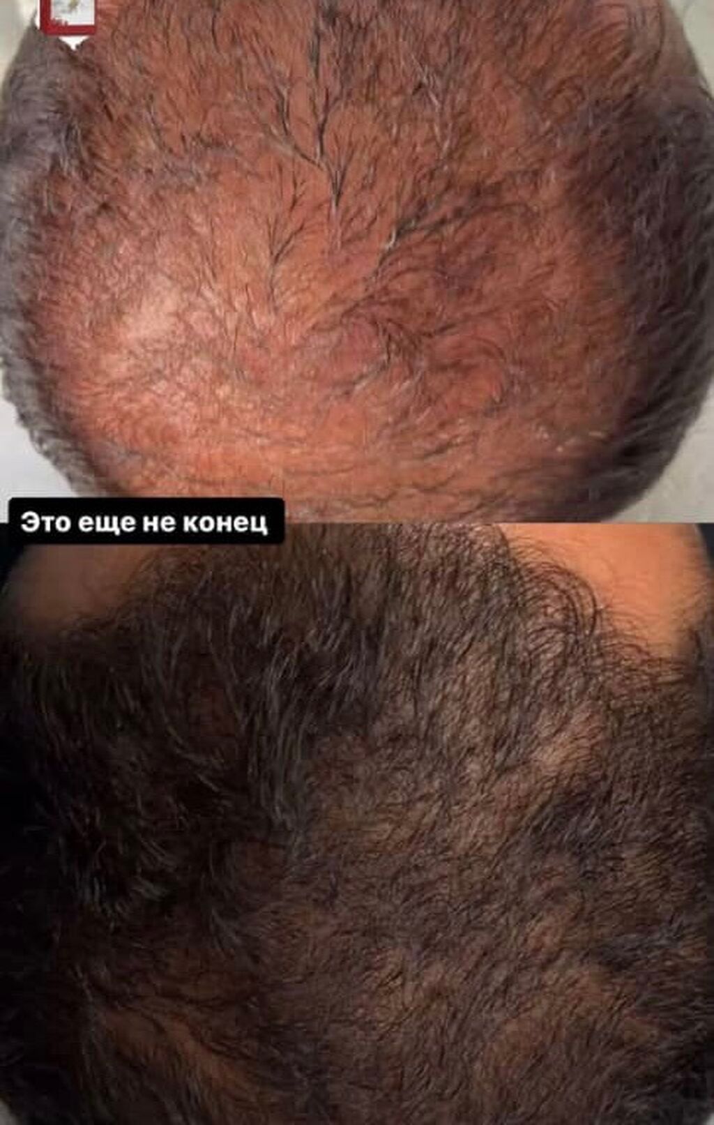 Спрей от выпадения волос от алопеции от лысины для роста, густоты — фото 2