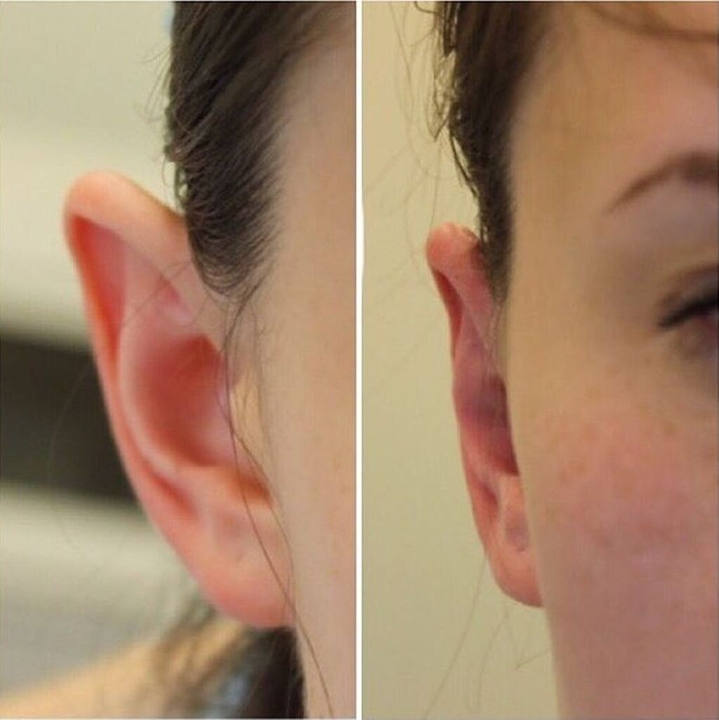 Пластическая операция на уши. Операция по уменьшению уха. Отопластика (пластика ушных раковин. Операция по уменьшению уха. Уменьшение ушей до и после.