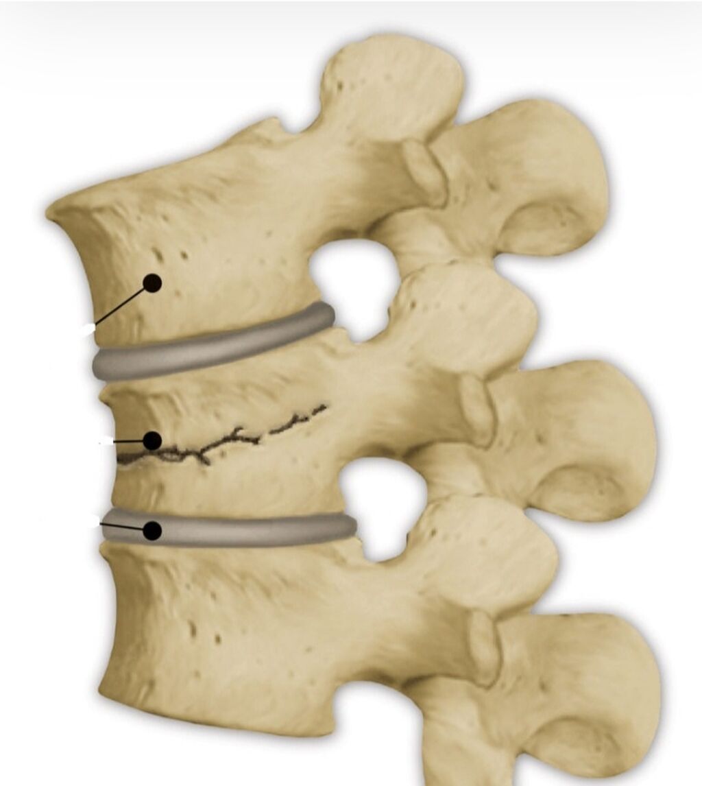 Компрессионный перелом тела т11 позвонка