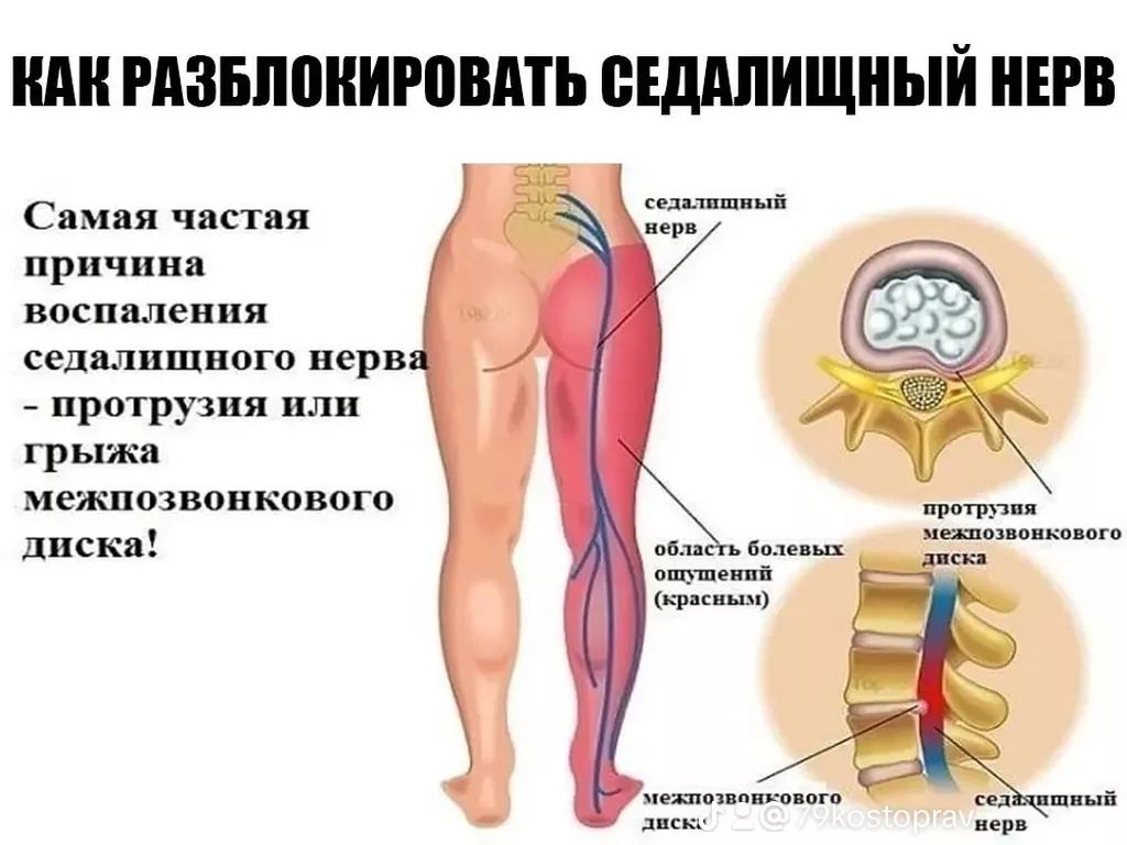 ЗАЩЕМЛЕНИЕ СЕДАЛИЩНОГО НЕРВА Массаж Новопавловка ᐈ 2 объявлений ᐈ lalafo.kg